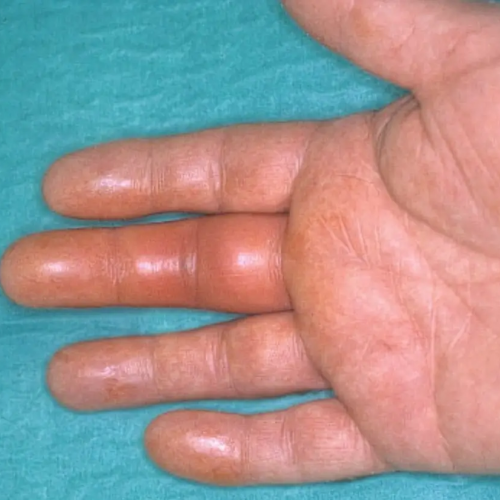Phlegmon de gaine du tendon