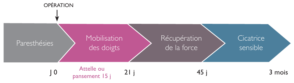 Evolution de l'opération du canal carpien